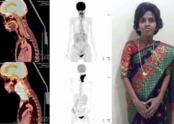 HCG Manavata Cancer Centre Tomotherapy radiation to tackle a life-threatening cancer case